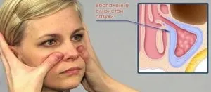 Верхньощелепної синусит що це таке, симптоми, лікування
