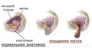 Випадання шийки матки - причини і лікування (шийки) Випадання шийки матки - причини і лікування
