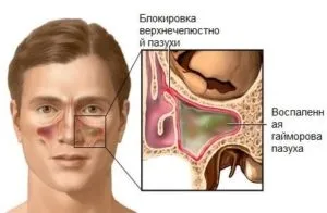 Верхньощелепної синусит що це таке, симптоми, лікування