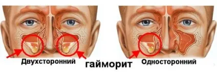 Верхньощелепної синусит причини, діагностика та лікування (діагностика) Верхньощелепної синусит причини, діагностика та лікування
