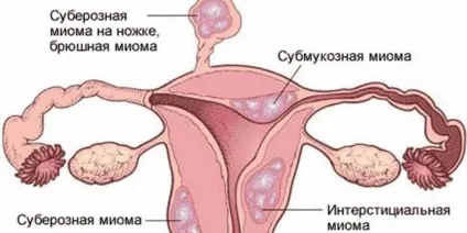 Види міоми матки - класифікація по розташуванню вузлів і розмірами пухлини з фото (вузлів) Види міоми матки - класифікація по розташуванню вузлів і розмірами пухлини з фото