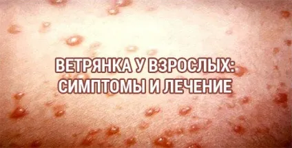 Вітрянка у дорослих і дітей лікування в домашніх умовах (дітей) Вітрянка у дорослих і дітей лікування в домашніх умовах
