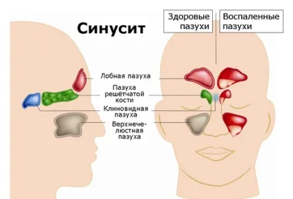 Верхньощелепної синусит причини, діагностика та лікування (діагностика) Верхньощелепної синусит причини, діагностика та лікування