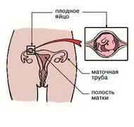 Позаматкова вагітність 1 (неоднорідні прідаткових структури) Позаматкова вагітність 1