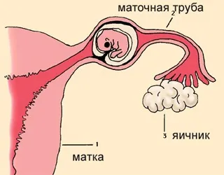 Позаматкова вагітність (вагітність Плодове яйце) Позаматкова вагітність