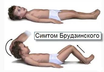 Вірусний менінгіт симптоми - 21 рецепт! (Менінгіт) Вірусний менінгіт симптоми - 21 рецепт!