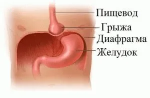 Виразка стравоходу симптоми і лікування (виразка) Виразка стравоходу симптоми і лікування