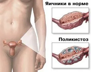 Яєчники - полікістоз яєчників - яєчниковий Дріллінг - здоров'я і стиль життя жінок