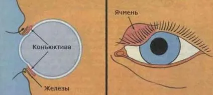 Ячмінь на оці - причини, симптоми і лікування хвороби (фото) (ячмінь) Ячмінь на оці - причини, симптоми і лікування хвороби (фото)