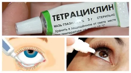 Ячмінь на оці - причини, симптоми і лікування хвороби (фото) (оці) Ячмінь на оці - причини, симптоми і лікування хвороби (фото)
