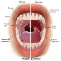 Як лікувати фарингіт у дитини, ніж полоскати горло (полоскати) Як лікувати фарингіт у дитини, ніж полоскати горло