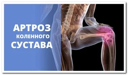 Як можна вилікувати артроз колінного суглоба (артроз) Як можна вилікувати артроз колінного суглоба