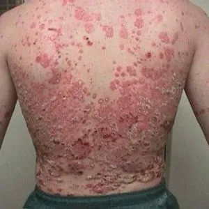 Заразний чи ні псоріаз все про симптоми і лікування псоріазу (новоутворення на тілі людини) Заразний чи ні псоріаз все про симптоми і лікування псоріазу