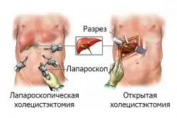 Алкоголь після видалення жовчного міхура чи можна вживати і в якій дозі (після) Алкоголь після видалення жовчного міхура чи можна вживати і в якій дозі