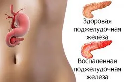 Алкоголь після видалення жовчного міхура чи можна вживати і в якій дозі (жовчного) Алкоголь після видалення жовчного міхура чи можна вживати і в якій дозі