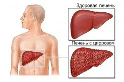 Алкоголь після видалення жовчного міхура чи можна вживати і в якій дозі (після) Алкоголь після видалення жовчного міхура чи можна вживати і в якій дозі