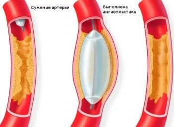 Ангіопластика - переваги, особливості процедури (переваги) Ангіопластика - переваги, особливості процедури