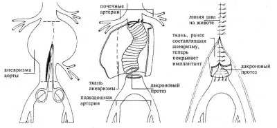 Аневризма аорти серця причини, симптоми, лікування