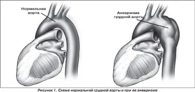 Аневризма аорти серця причини, симптоми, лікування