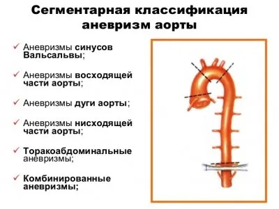Аневризма аорти серця причини, симптоми, лікування
