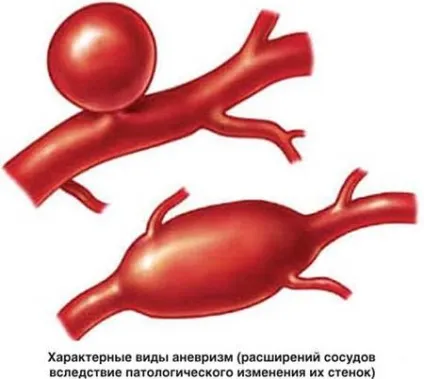 Аневризма аорти серця причини, симптоми і чи потрібна операція для лікування (аневризма) Аневризма аорти серця причини, симптоми і чи потрібна операція для лікування