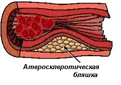 Атеросклероз артерій нижніх кінцівок (атеросклероз) Атеросклероз артерій нижніх кінцівок