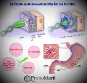 Бактерії ліки при інфекції в сечі, шлунку, кишечнику (шлунку) Бактерії ліки при інфекції в сечі, шлунку, кишечнику