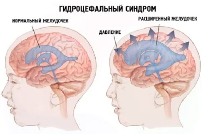 Базилярна імпресія (інвагінація, вдавлення) симптоми, лікування, чим небезпечна (базилярна інвагінація) Базилярна імпресія (інвагінація, вдавлення) симптоми, лікування, чим небезпечна