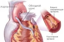 Хвороба Нотта причини, симптоми, лікування (причини) Хвороба Нотта причини, симптоми, лікування