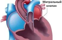 Хвороба Нотта причини, симптоми, лікування (хвороба) Хвороба Нотта причини, симптоми, лікування