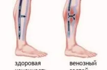 Хвороба Нотта причини, симптоми, лікування (хвороба) Хвороба Нотта причини, симптоми, лікування