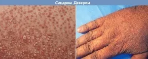 Хвороба Девержі опис, симптоми і лікування (хвороби шкіри) Хвороба Девержі опис, симптоми і лікування