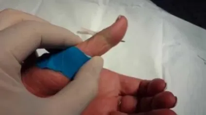 Хвороба Нотта ознаки, симптоматика недуги, його лікування у дорослих і дітей (недуги) Хвороба Нотта ознаки, симптоматика недуги, його лікування у дорослих і дітей