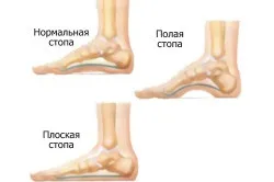 Болить склепіння стопи при ходьбі лікування (звід) Болить склепіння стопи при ходьбі лікування