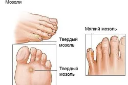 Болить склепіння стопи при ходьбі лікування (звід) Болить склепіння стопи при ходьбі лікування