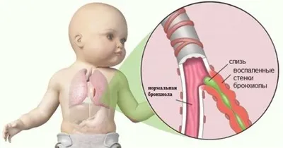 Бронхиолит у дітей симптоми, лікування і профілактика (бронхіоліт Віруси які) Бронхиолит у дітей симптоми, лікування і профілактика