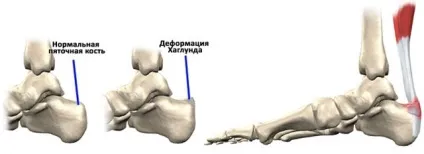 Хвороба Хаглунд шінца операція, лікування консервативними методами (лікування) Хвороба Хаглунд шінца операція, лікування консервативними методами