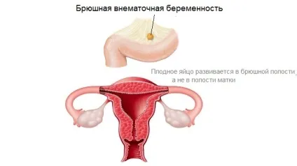 Черевна позаматкова вагітність причини, симптоми, діагностика та лікування (вагітність) Черевна позаматкова вагітність причини, симптоми, діагностика та лікування