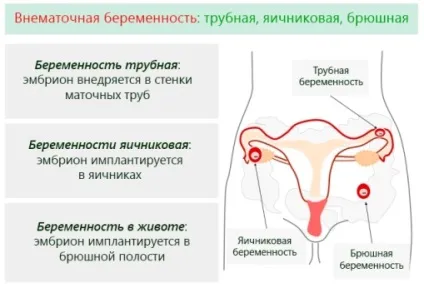 Черевна вагітність симптоми, діагностика та лікування (симптоми) Черевна вагітність симптоми, діагностика та лікування