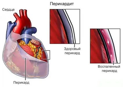 Болить в області серця під час вдиху можливі причини і лікування (можливі) Болить в області серця при вдиху можливі причини і лікування