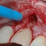 Чорні плями на зубах коричневі плями карієсу (карієсу) Чорні плями на зубах коричневі плями карієсу