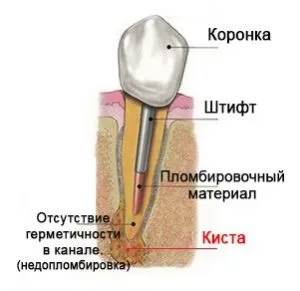 Чим небезпечний флюс і як уникнути смертельних ускладнень кісти (флюс) Чим небезпечний флюс і як уникнути смертельних ускладнень кісти