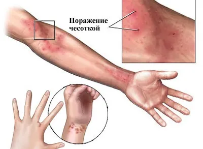 Свербить короста що робити