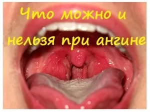 Що можна і не можна робити при ангіні (ангіні) Що можна і не можна робити при ангіні