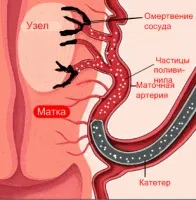 Що таке інтрамуральна міома матки (таке) Що таке інтрамуральна міома матки
