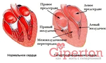 Що потрібно знати про ниркової гіпертонії (знати) Що потрібно знати про ниркової гіпертонії