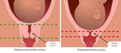 Що означає коротка шийка матки при вагітності (коротка) Що означає коротка шийка матки при вагітності