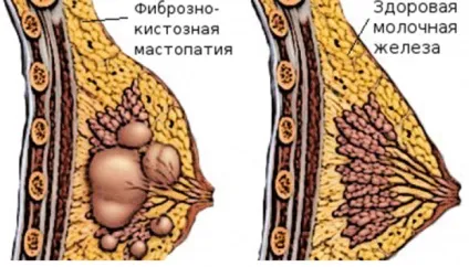 Що таке мастопатія