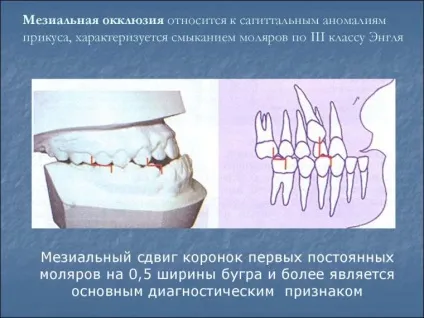Що таке оклюзія в стоматології центральна, дистальна, мезиальная і інші види (дистальна) Що таке оклюзія в стоматології центральна, дистальна, мезиальная і інші види