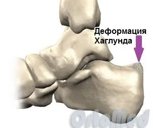 Деформація Хаглунд причини симптоми лікування, остеофіт п'яткової кістки (причини) Деформація Хаглунд причини симптоми лікування, остеофіт п'яткової кістки